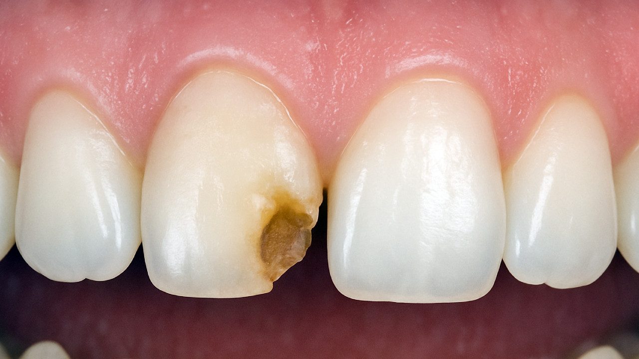 Before-dental-crown-treatment