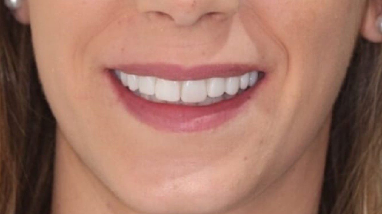 After-whitening+implants
