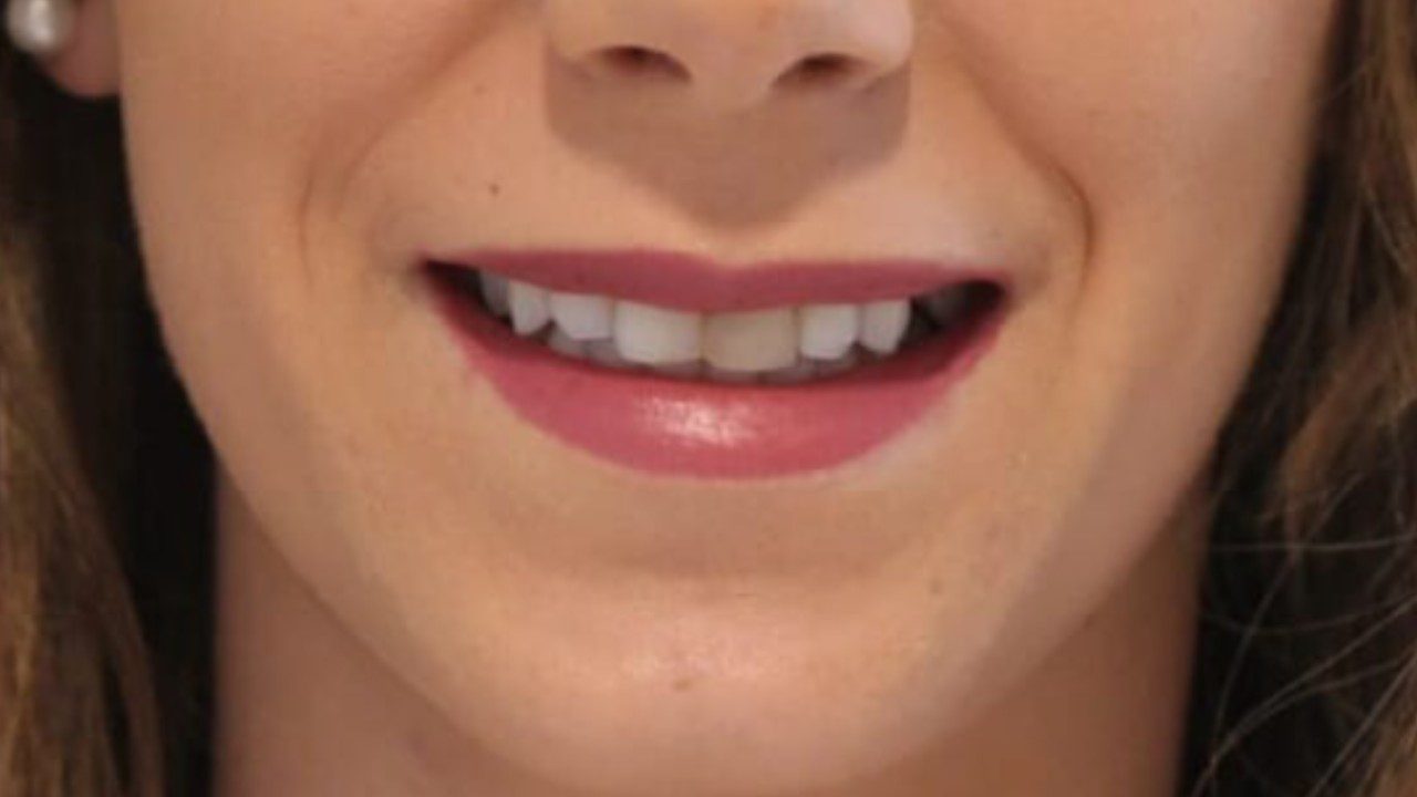 Before-whitening+implants