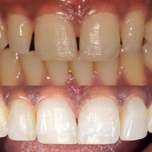 Phil_Broughton_Whitening+Composite
