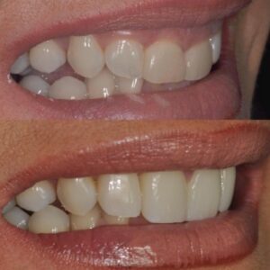Phil_Broughton_natural_porcelain_veneers