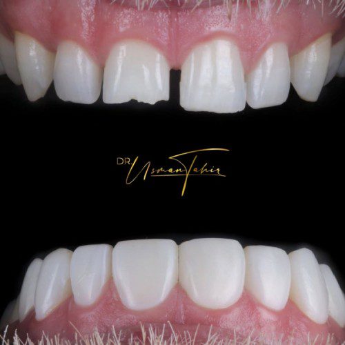 Composite_Veneers