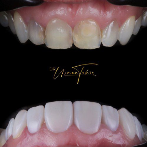 Composite_Veneers_for_Chipped_Teeth