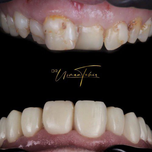 Gum_Disease_and_Composite_Veneers