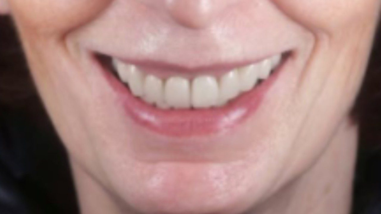 After-Smile_makeover_Usman_Patient