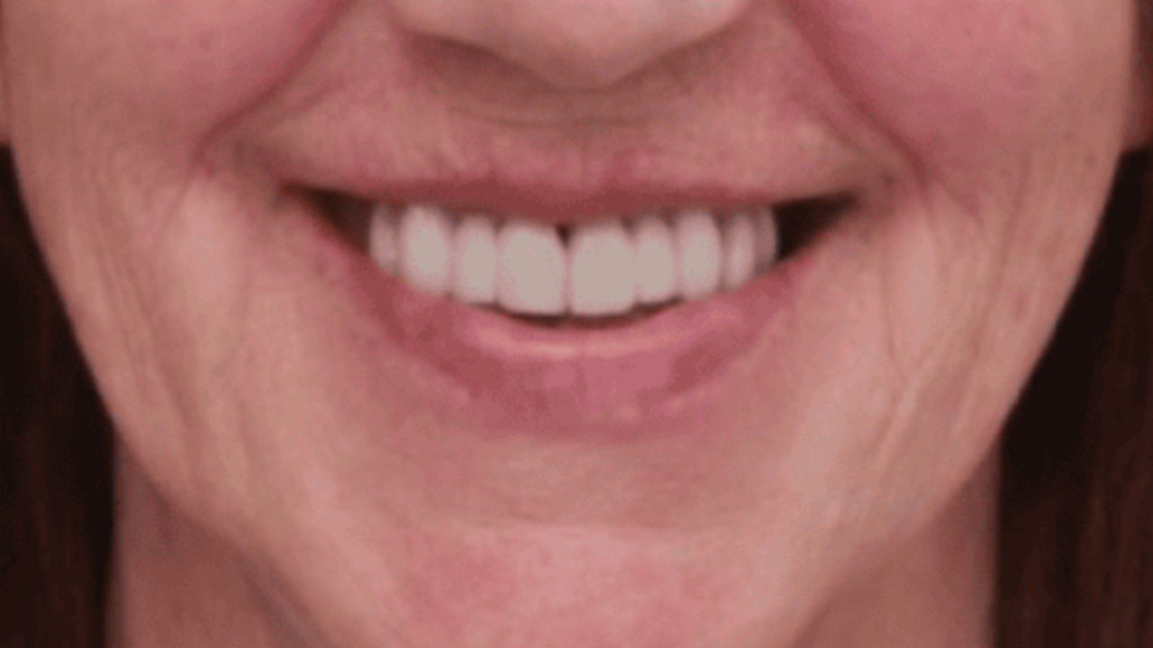 After_Composite_Veneers_in_Bolton