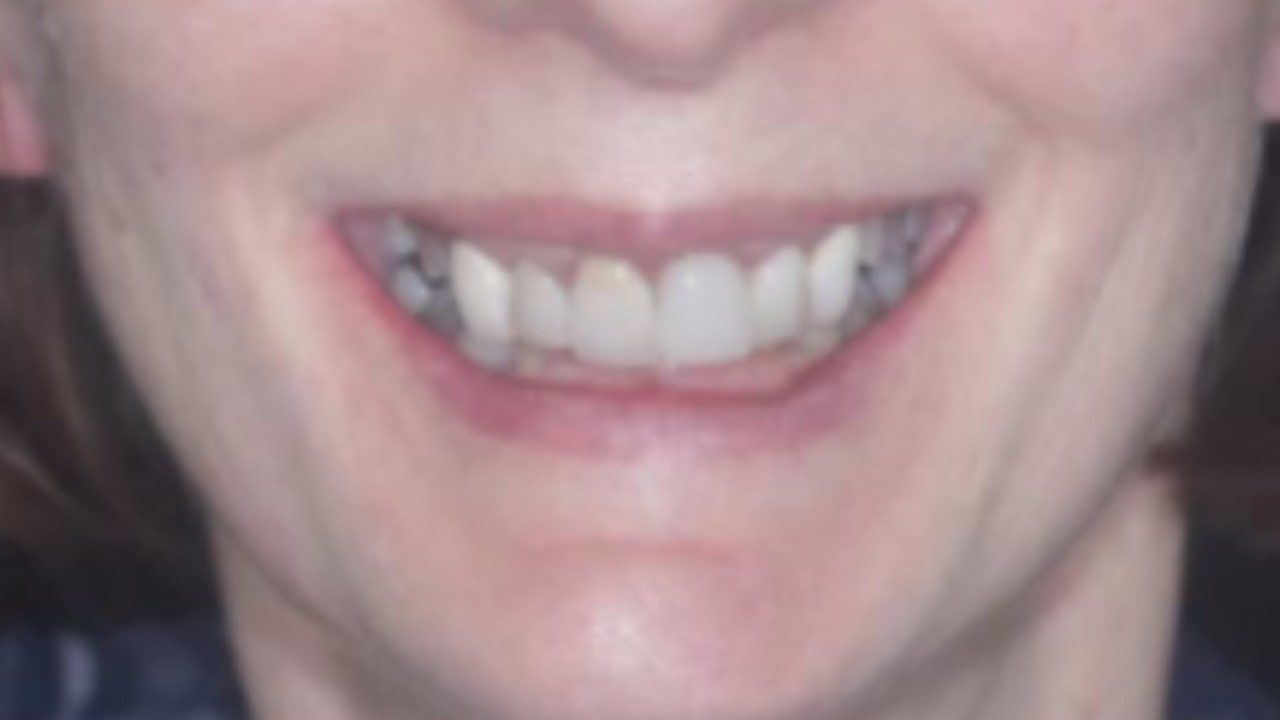Before-Smile_makeover_Usman_Patient