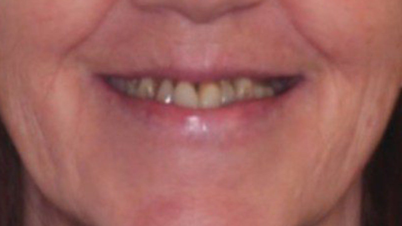 Before_Composite_Veneers_in_Bolton