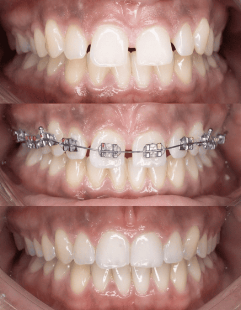 Daniel_Chia_Patient_Fixed_Braces_Progress