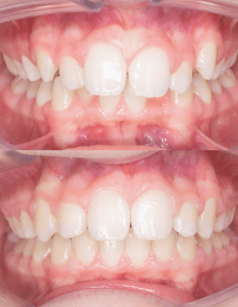 Daniel_Chia_Patient_Front_Before_and_After