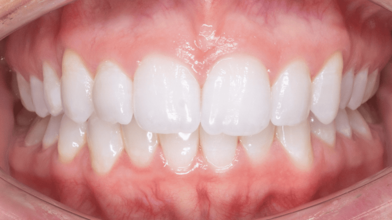 Daniel_Chia_Patient_Misaligned_Teeth_After