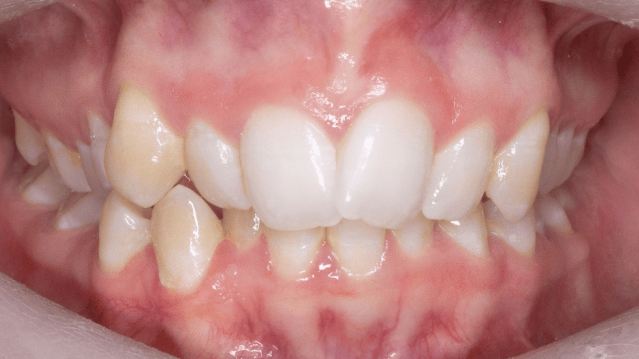 Daniel_Chia_Patient_Misaligned_Teeth_Before