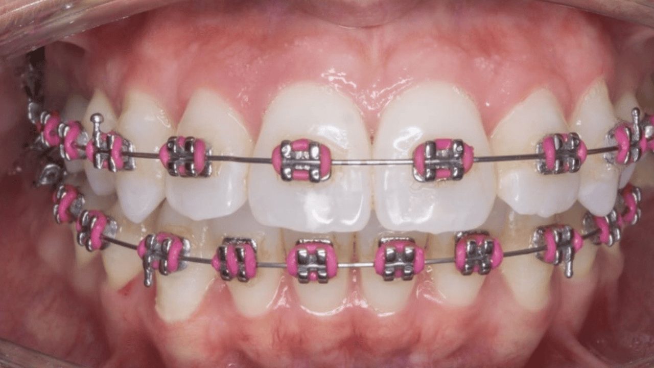 Daniel Chia's patient teeth after fixed braces are installed.