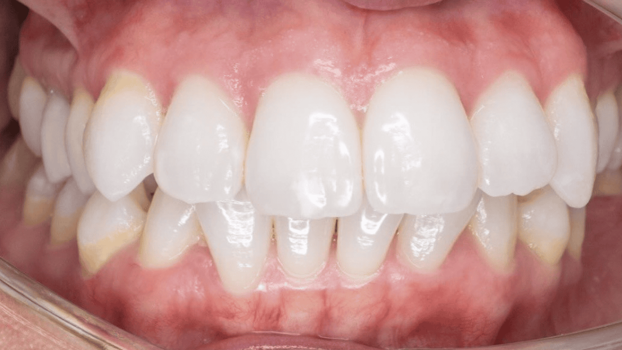 Daniel Chia's patient teeth before fixed braces are installed.